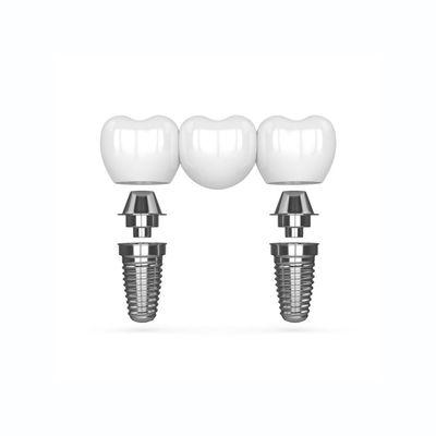 Multi-Tooth Implants, also called "Bridges", are a great way to replace a series of bad or missing teeth.