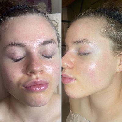 Bright and Glow Facial