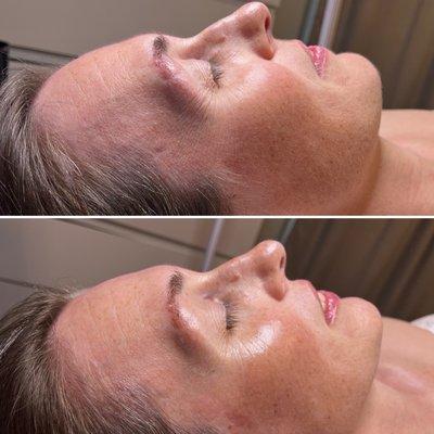 Before and after dermaplaning.