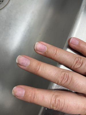 Nails filed into nail bed