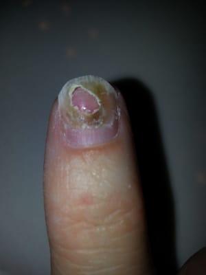 My nail 2 weeks after the incident