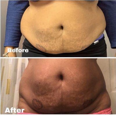 Progress photos of laser Lipo + Lipo Cavitation