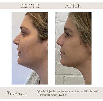 Before and after of kybella treatment for a sharper jawline complimented with dermal fillers for extra definition