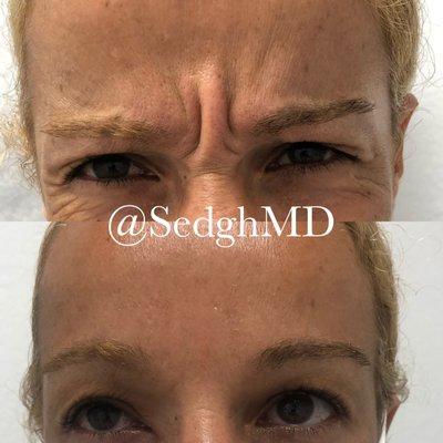 Amazing Botox results. Dr. Ray Sedgh, MD