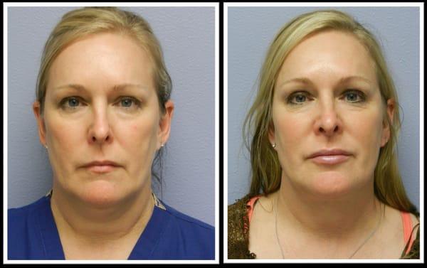 Procedure: Laser Lipo - Neck 

Actual patient of Dr. Hannah Vargas