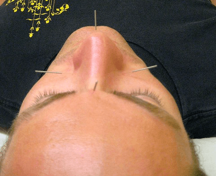 Body Acupuncture