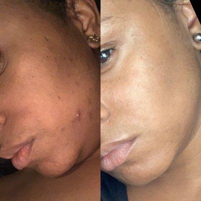 Acne? Hyperpigmentation? No Problem! We Have Solutions