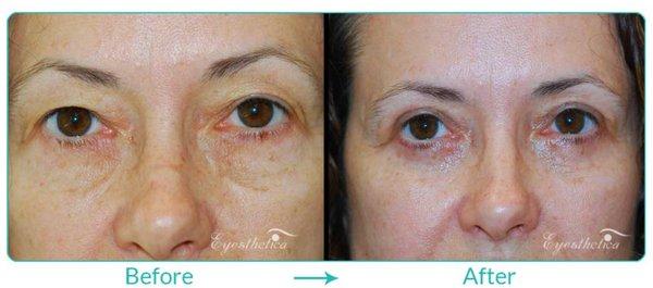 Before and After: Upper Blepharoplasty (Upper Eyelid Lift) by Dr. Steven C. Dresner