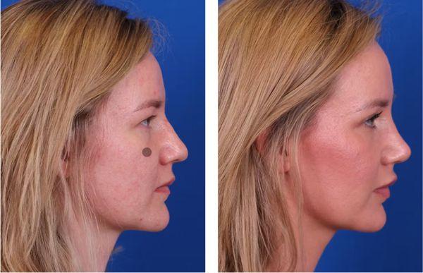 Rhinoplasty before and after