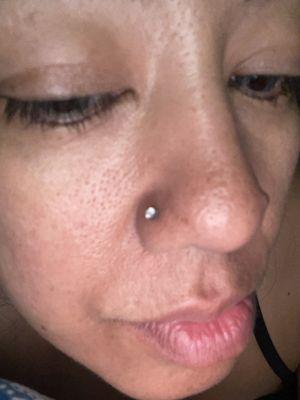 Healed nose piercing