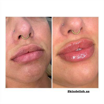 Lip filler to enhance her beautiful lippies