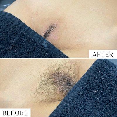 Brazilian Sugar Wax in Cerritos, CA