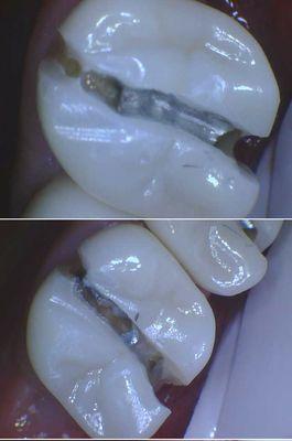 Amalgam fillings left and covered up with a new crowns!!!