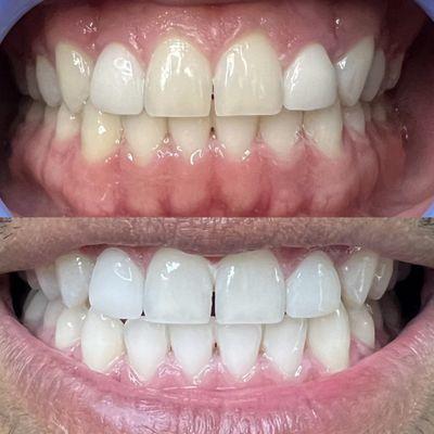 Teeth whitening client