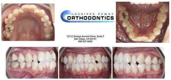 Before braces - severe crowding and crossbite