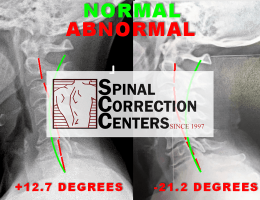 Before and After the Initial Phase of Correction with Resolution of Migraines and Arm Pain