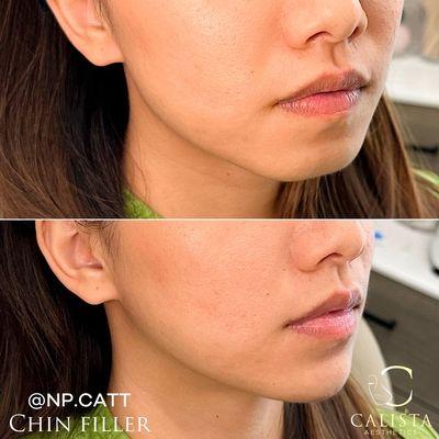 Chin filler by NP Cat