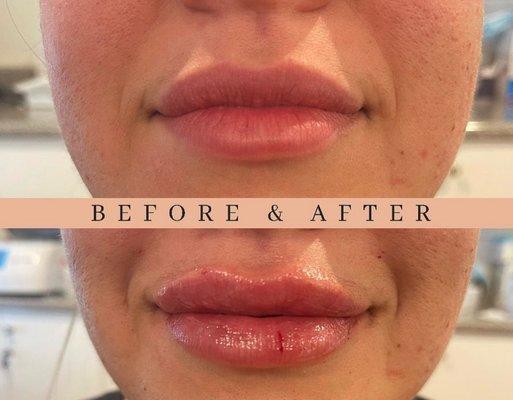 Naturally done lips    Before and After Lips Book your free consultation with us and find out about our October specials  818-696-2156