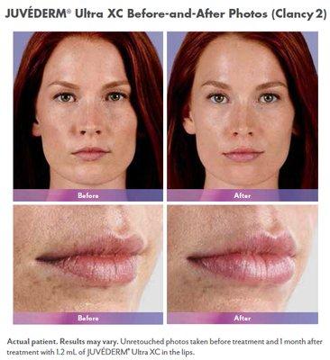 Juvéderm® - Lips Before and After