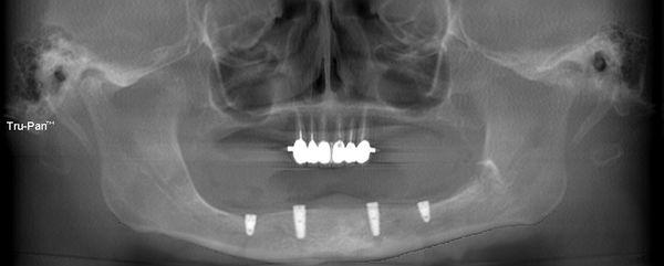 Dental Implants