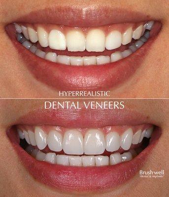 Cosmetic Veneers to Correct Past Botched Treatment