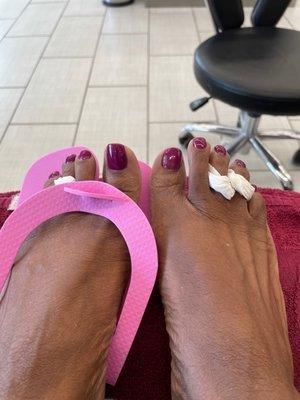 Toe nails uneven