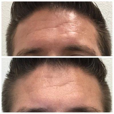 Non-Surgical Wrinkle Treatment with intense focused ultraound