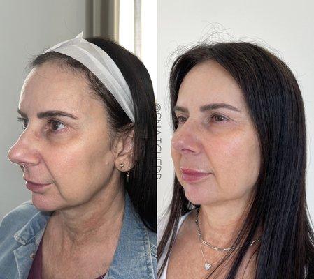 NON SURGICAL FACE LIFT