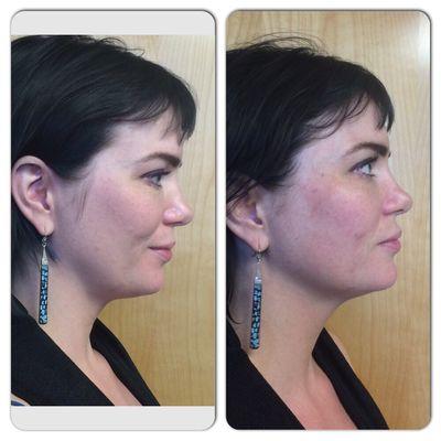 Bellafill before and after. Only FDA approved filler for 5 year results. Results improve over time.