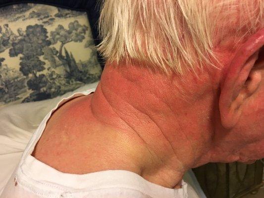 Severe Sunburn from Golden Home Service employee leaving patient out in sun for extended time