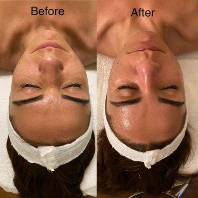 Hydrodermabrasion facial