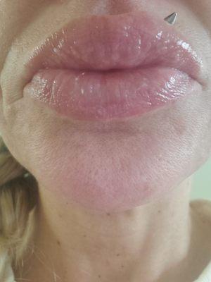 Before my 5th syringe of juvederm ultra plus.