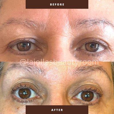 Plasma Pen Fibroblast Treatment for an Upper Eyelid Lift and to smoothen out Frown Lines (in between eyes). 
Photo: 3 weeks post-treatment.