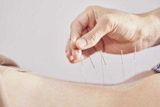 Acupuncture