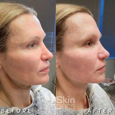 Jawline augmentation