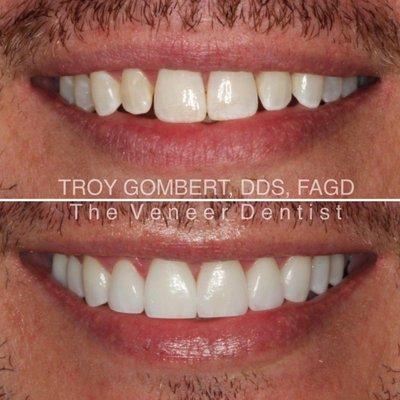 smile makeover with porcelain veneers.