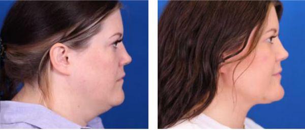 Minimally invasive Neck lift