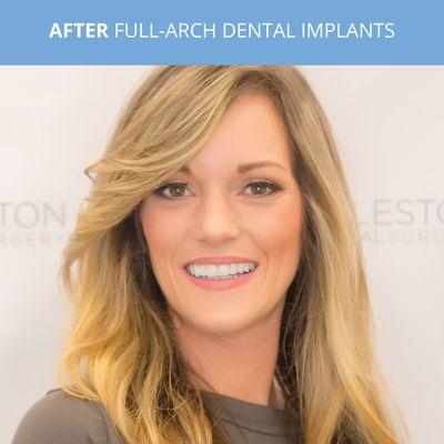 AFTER Guided Full-Arch Dental Implants