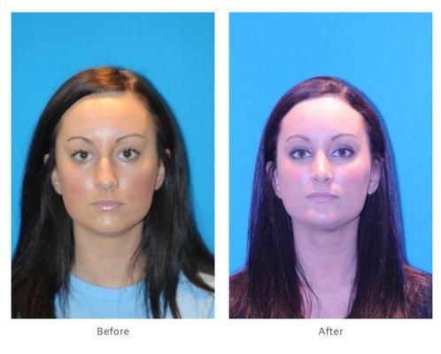 25 Year Old Female Rhinoplasty