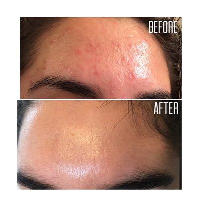 Acne Reduction after the 60 Day Challenge.