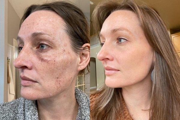 Before and after laser treatment