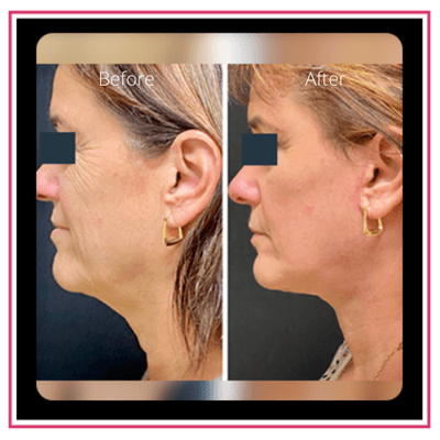 Face/Neck Lift & CO2 Laser Skin Resurfacing