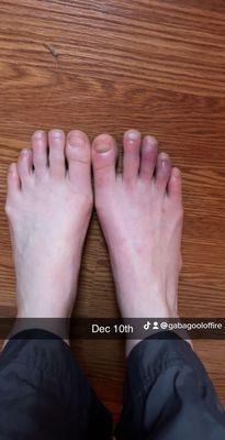 Purple middle toes on right foot