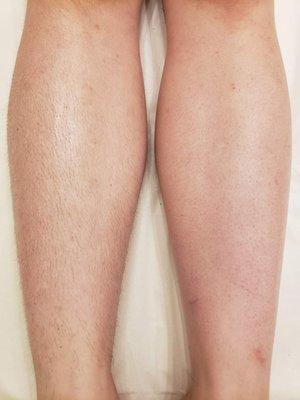 Left Leg: Before 
Right Leg: After