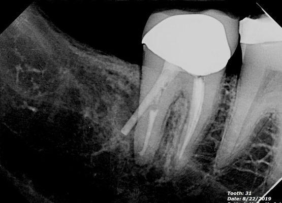 My poorly installed crown and post by Cristene Maas, DDS led to infection and eventually a lost tooth and implant.