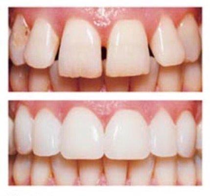 Porcelain veneers