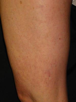 spider veins after treatment