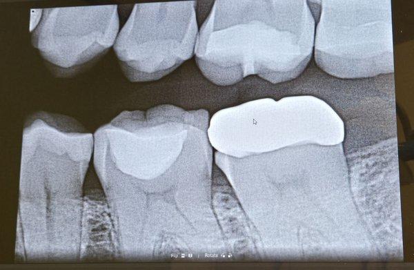 Per my new dentist, the rt side of crown is perfect, but the left isn't flush. My "permanent crown" popped eating Fries in 5 mos