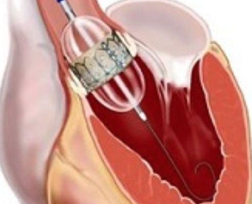 Transcatheter Aortic Valve Replacement (TAVR)