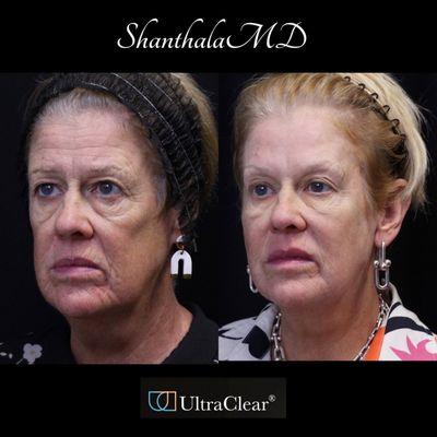 Life changing results Pan facial Rejuvenation  at shanthalaMD